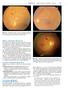 Objawy retinopatii cukrzycowej