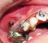 Implanty w ortodoncji nowe możliwości leczenia na podstawie piśmiennictwa