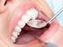 Wpływ choroby refluksowej na stan jamy ustnej