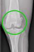 Ubytek chrzåstki IV na powierzchni bloczka ko ci skokowej leczony przeszczepem chrzæstno-kostnym (OATS) z kolana i mikrozæamaniami opis przypadku