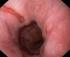 1. Stany i zmiany przedrakowe raka gruczołowego przełyku, refluksowe zapalenie przełyku, przełyk Barretta, dysplazja w przełyku Barretta