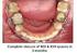 Clinical procedure and the use of InPlant in orthodontic patients