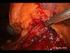 Całkowite laparoskopowe wycięcie macicy wskazania i powikłania u 158 pacjentek