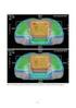 Kontrola systemów planowania leczenia 3D w radioterapii wiązkami zewnętrznymi fotonów i elektronów