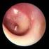 Profil oporności bakterii w ostrym zapaleniu ucha środkowego u dzieci po nieskutecznej antybiotykoterapii
