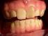 Zaburzenia mineralizacji twardych tkanek zębów a próchnica u letnich dzieci wrocławskich