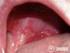 Przewlekłe wrzodziejące zapalenie jamy ustnej. Związek z liszajem płaskim