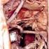 Arteriografia pnia trzewnego i tętnicy krezkowej górnej