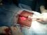Laparoskopowe zaopatrzenie przepukliny brzusznej z użyciem implantu Proceed trzy lata obserwacji pierwszej grupy chorych