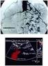 Endovascular treatment of Leriche s syndrome (type D TASC II) a case report