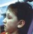 Zespół Noonan u 8-letniej pacjentki opis przypadku 8 - year - old patient with Noonan syndrome - case report