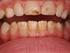 Rola IgA śliny w chorobach jamy ustnej przegląd piśmiennictwa