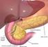 Postępowanie u chorych z endokrynną postacią raka trzustki, w tym w przypadkach o mieszanym utkaniu histologicznym