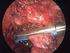 Rak jelita grubego komplikacje chirurgicznej resekcji laparoskopowej