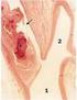 Carotid plaque instability in symptomatic carotid disease