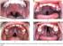 Morphology of the mandible in bilateral cleft of the lip, alveolar ridge and palate patients