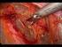 Całkowita laparoskopowa radykalna histerektomia z obustronną limfadenektomią miedniczą w leczeniu raka szyjki macicy w stadium IB opis przypadku