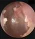 Ostre zapalenie ucha środkowego (OMA)